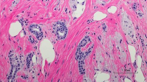 Breast Cancer Patients 60% More Likely To Die of Cancer After Surviving a Heart Attack