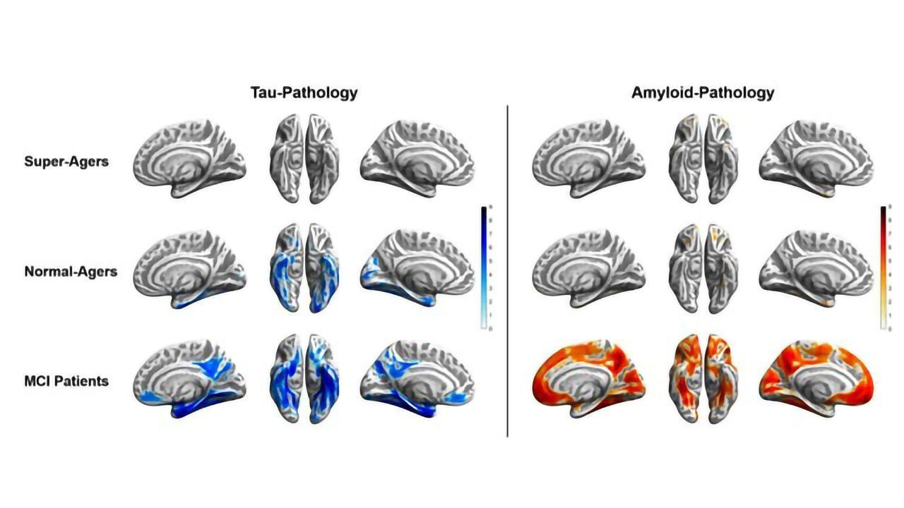 Image Showing Super-agers' Alzheimer's-resistant Brains Wins Prize