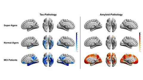 Image Showing Super-agers' Alzheimer's-resistant Brains Wins Prize