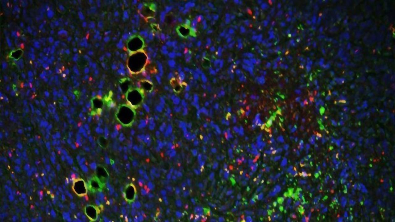 Breast Cancer Cells Disrupt Local Immune Defenses