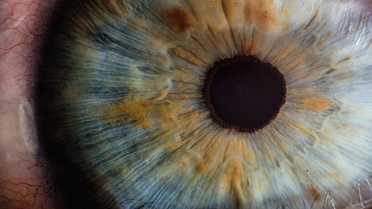 Drug Target for Dry Age-Related Macular Degeneration Discovered