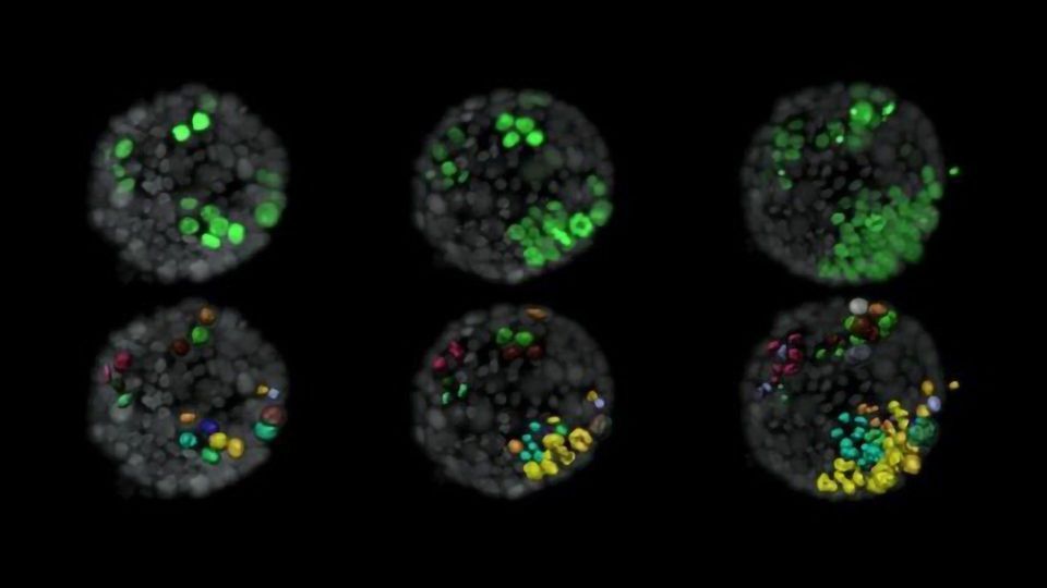 Neighboring Mutated Cells Help Kickstart Breast Cancer content piece image