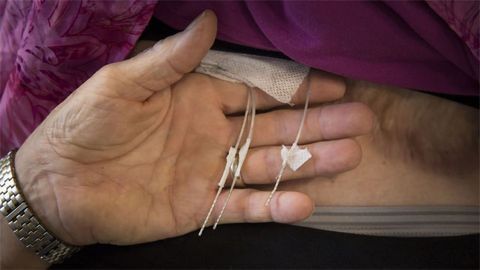 Spinal Cord Stimulators Restore Sense of Touch in Lost Limbs
