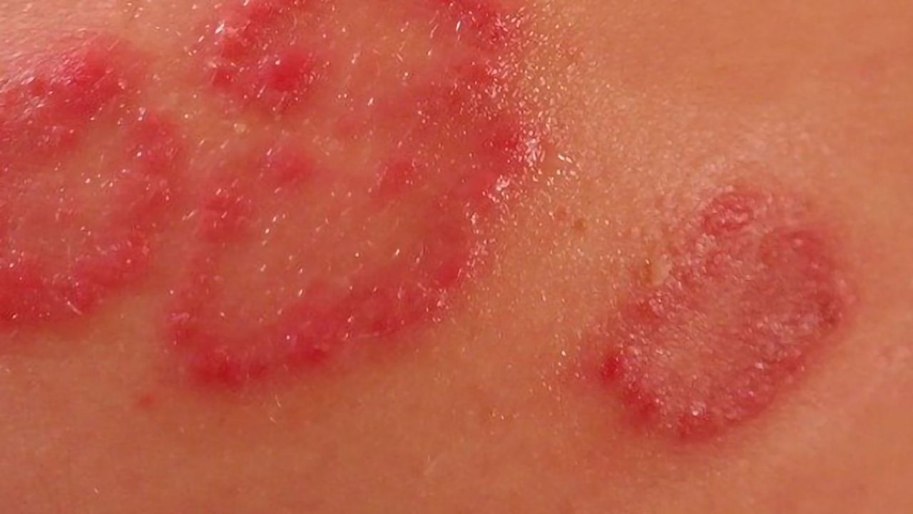 Novel Drug Delivery Method Gets Under the Skin of Psoriasis