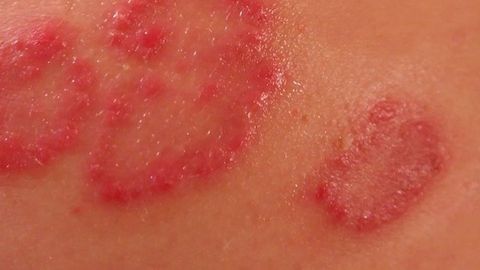 Novel Drug Delivery Method Gets Under the Skin of Psoriasis