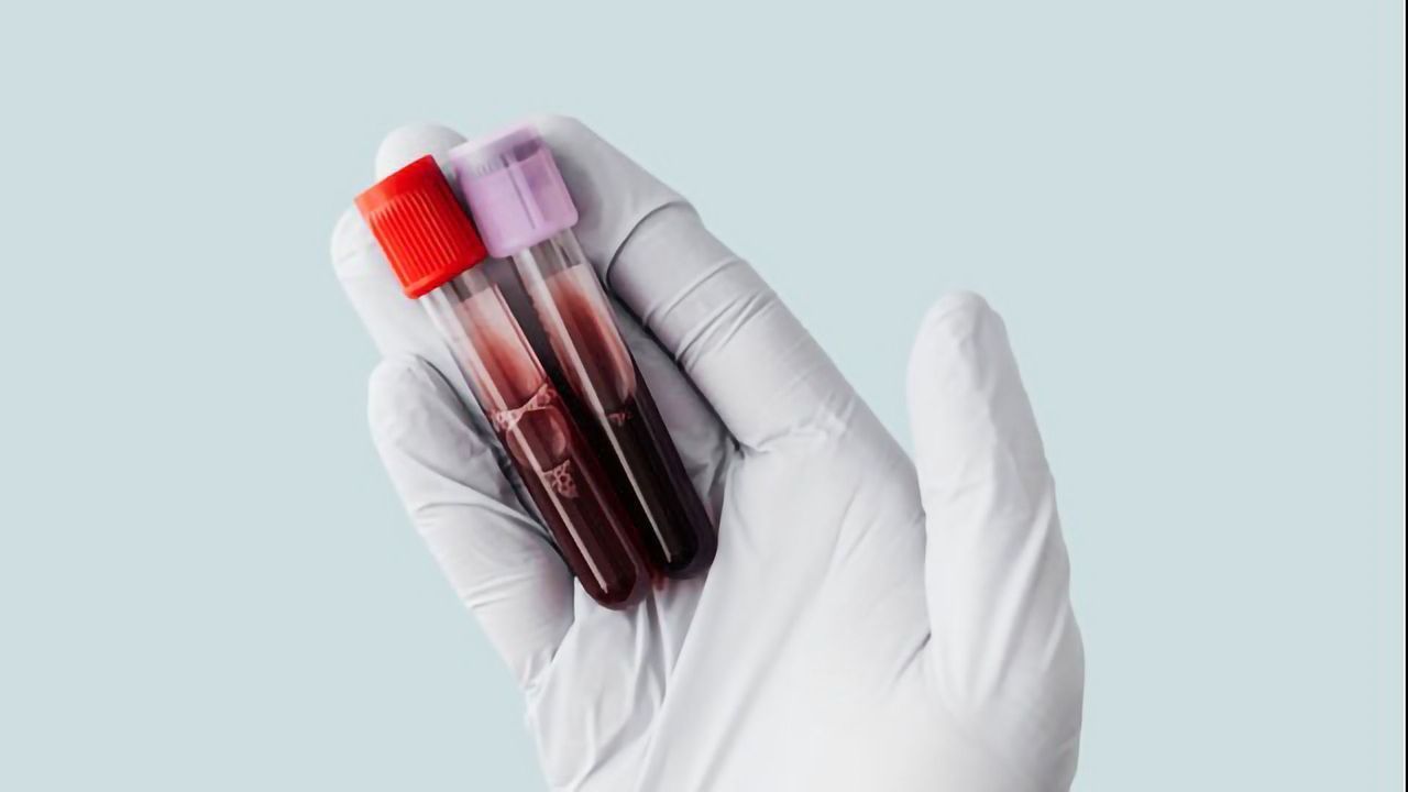 FDA Approves Blood Test for Identifying Novel Allergic Sensitization to Red Meat