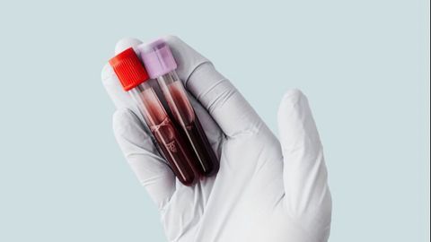FDA Approves Blood Test for Identifying Novel Allergic Sensitization to Red Meat