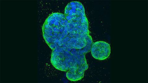 Human Breast Cancer Cells Human Breast Cancer Cells