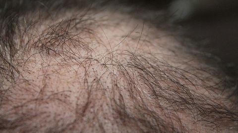 MicroRNA Shows Promise for Hair Regrowth