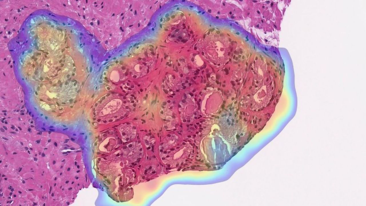 New AI Study Diagnoses Prostate Cancer With Near-Perfect Accuracy
