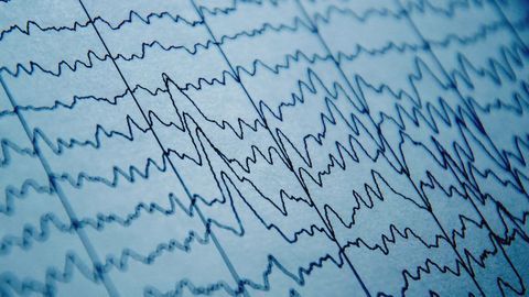 Brain Waves Can Predict Pain Sensitivity