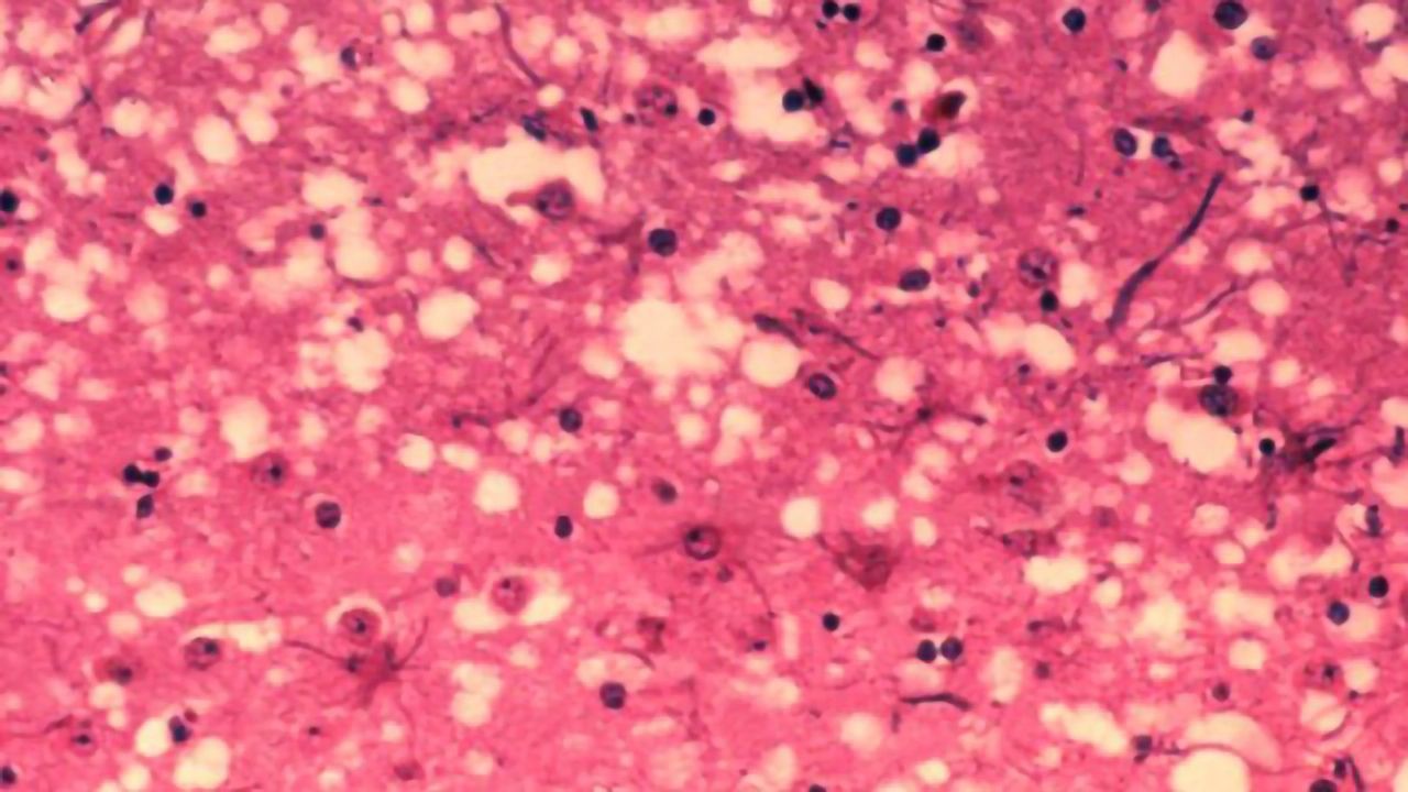Antisense Therapy Could be Effective at Treating Prion Disease