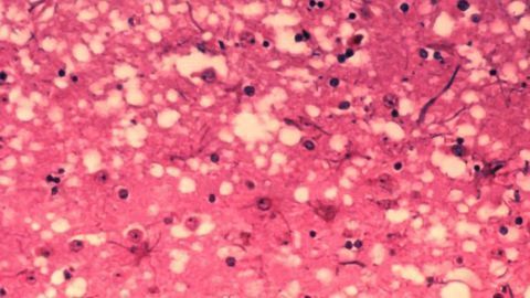 Antisense Therapy Could be Effective at Treating Prion Disease