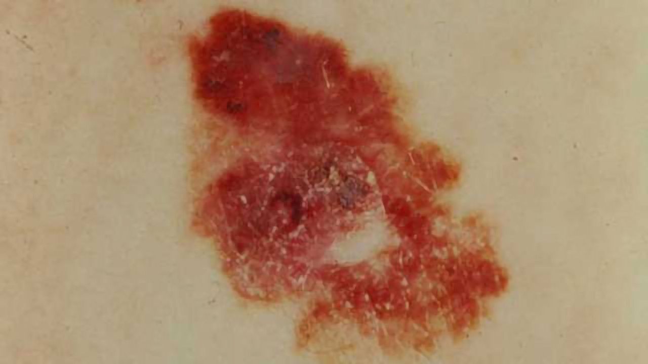 Monitoring Skin Cancer Using Molecules in Urine