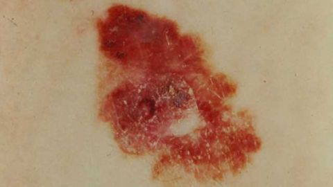 Monitoring Skin Cancer Using Molecules in Urine