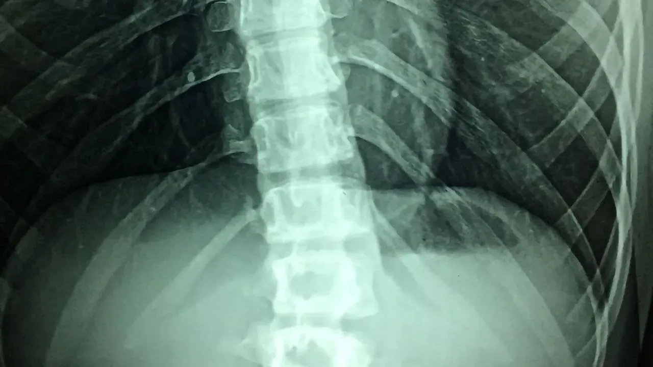 https://www.technologynetworks.com/tn/news/treatment-option-for-spinal-cord-injuries-osmotic-therapy-device-reduces-swelling-preventing-338578