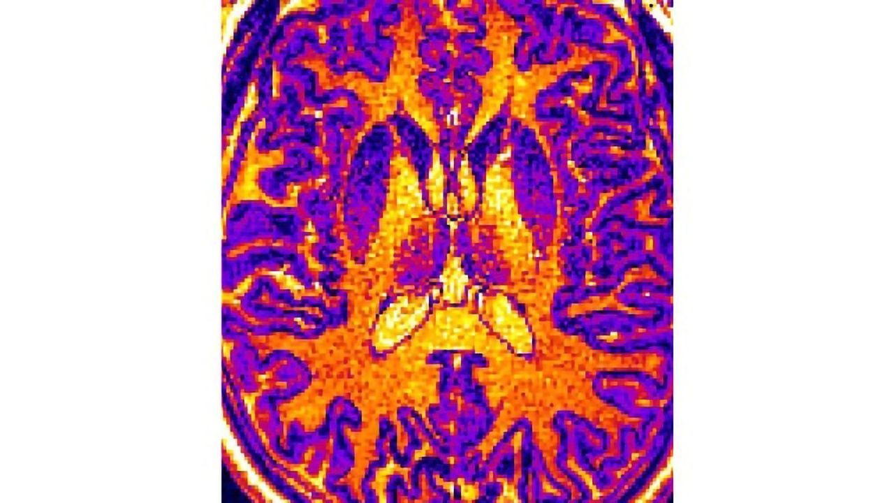 Can Machine Learning and Brain Imaging Create Better Diagnostics for Mental Illness?