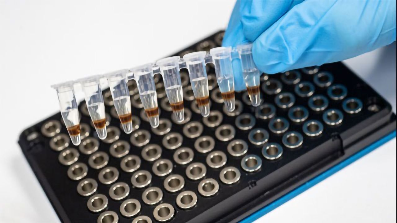 More Evidence Links Diabetes Biomarkers and Alzheimer's Disease