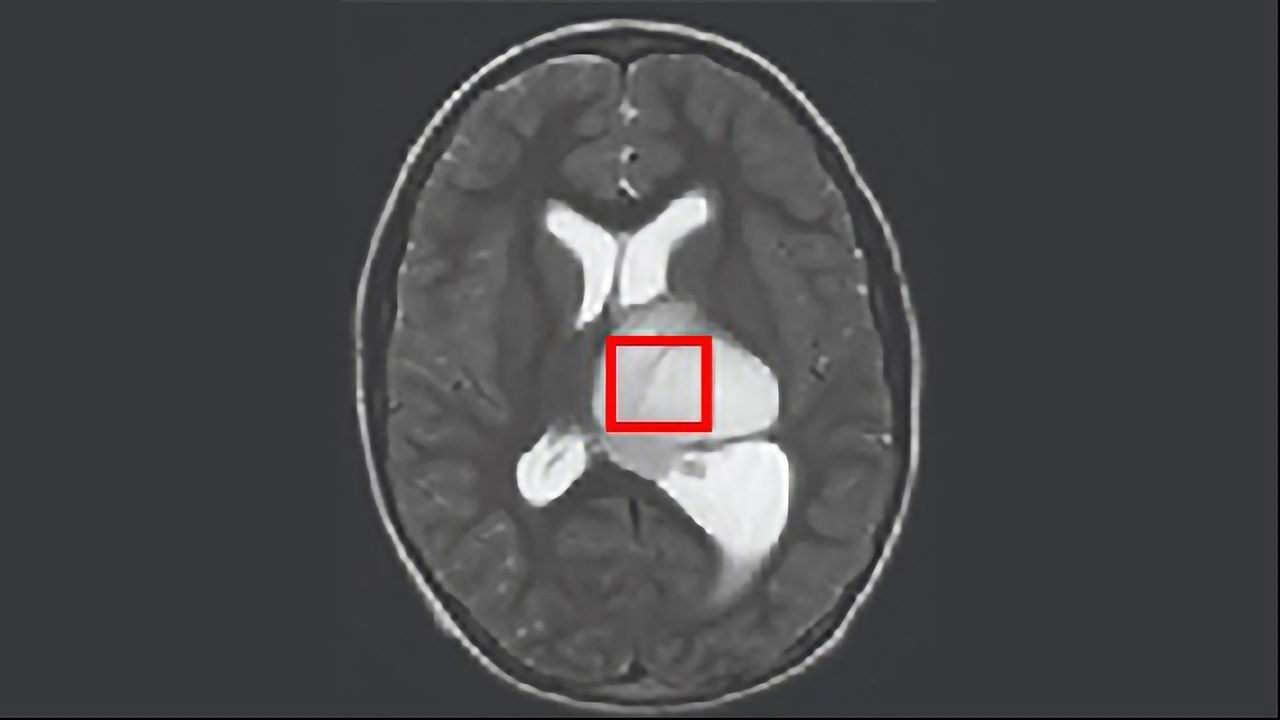 Ketone-Supressing Drug Combats Rare Brain Cancer in Mice