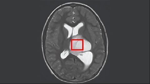 Ketone-Supressing Drug Combats Rare Brain Cancer in Mice