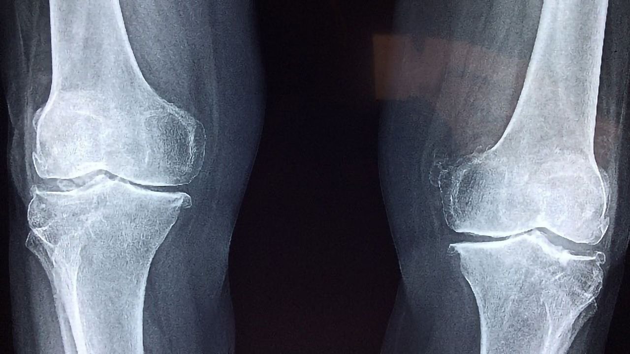 Researchers Find Method to Regrow Cartilage in the Joints