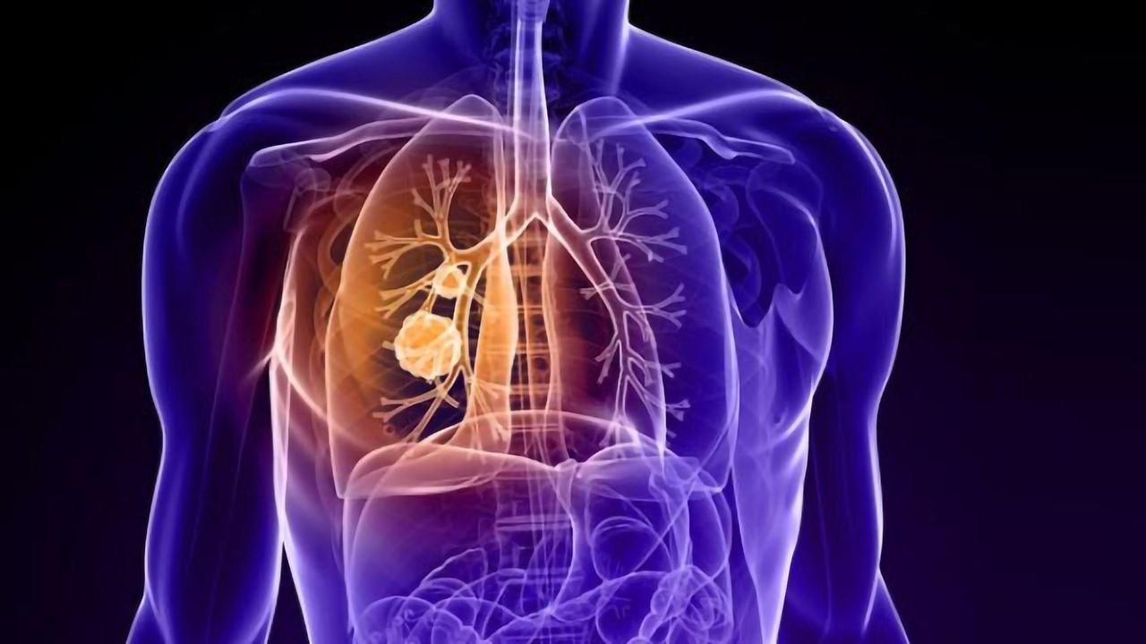 Boosting NK Cells’ Ability To Fight Lung Cancer