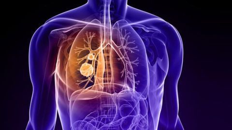 Boosting NK Cells’ Ability To Fight Lung Cancer