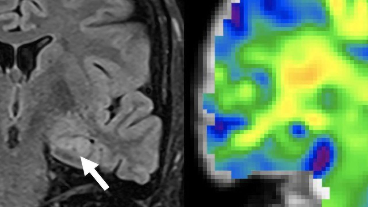 Using Magnetic Resonance Elastography to Detect Epilepsy