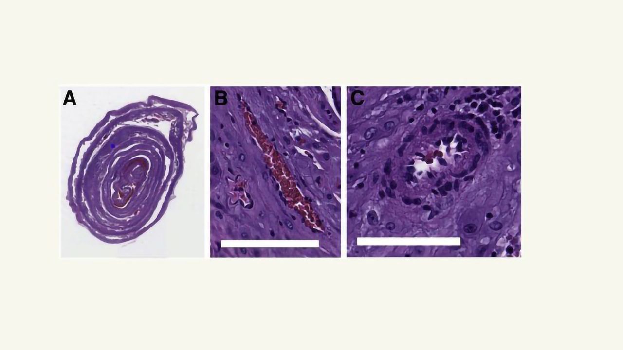 Machine Learning Probes Placenta To Protect Future Pregnancies