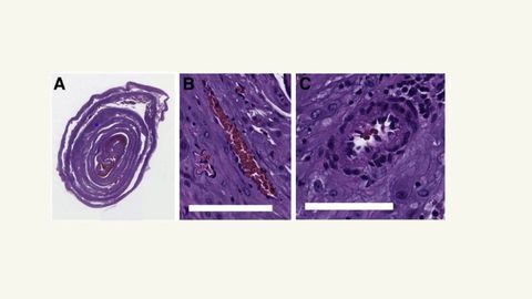 Machine Learning Probes Placenta To Protect Future Pregnancies