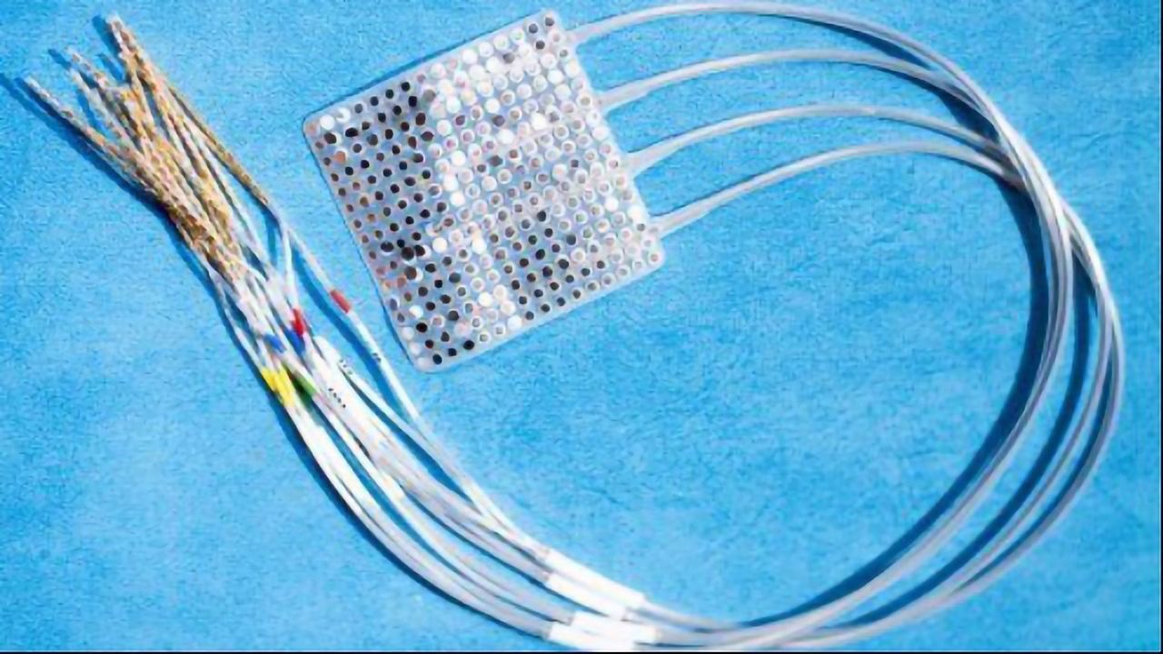 First "Plug and Play" Brain Prosthesis Helps Paralysis Patient