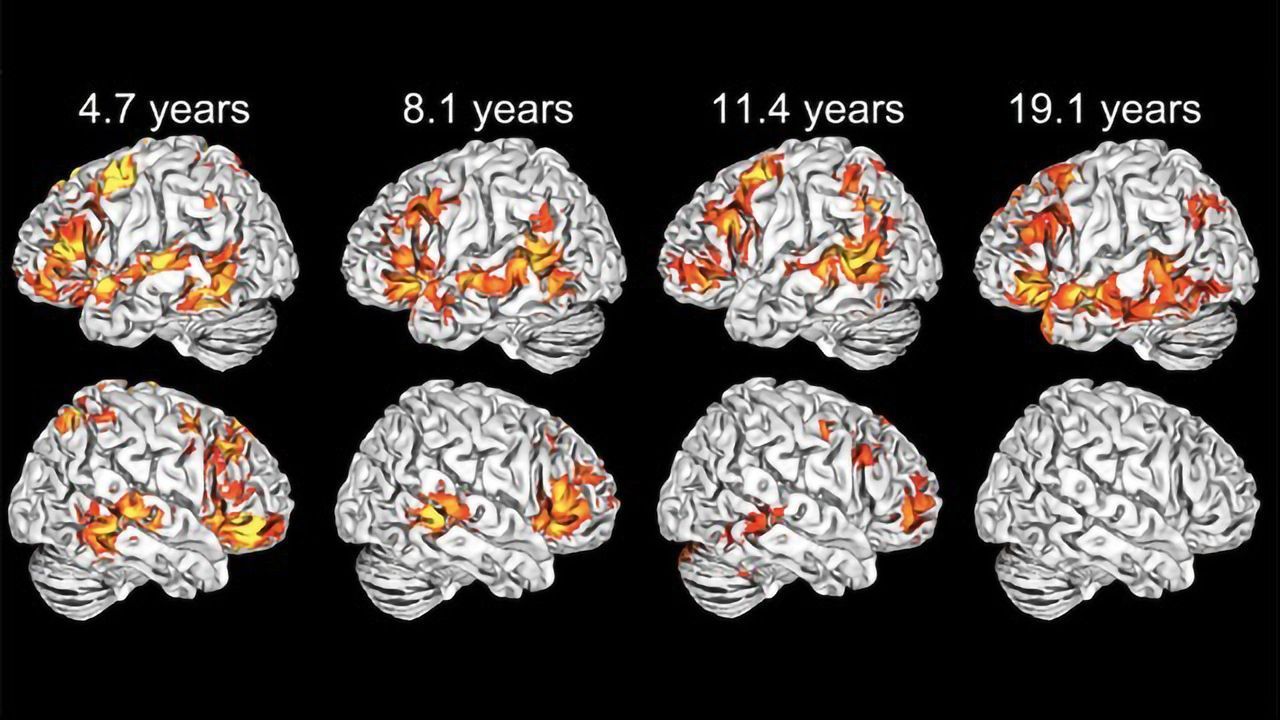 Young Children, Unlike Adults, Use Both Sides of Their Brain To Learn Language