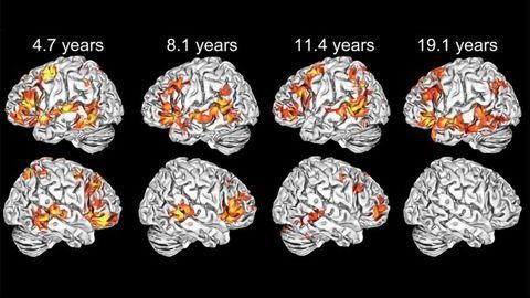 Young Children, Unlike Adults, Use Both Sides of Their Brain To Learn Language