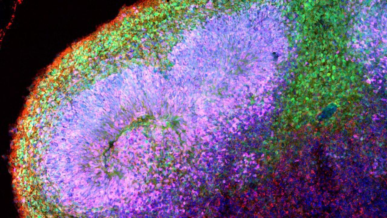 Brain Organoids Reveal the Early Stages of Angelman Syndrome
