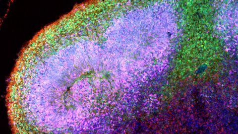 Brain Organoids Reveal the Early Stages of Angelman Syndrome