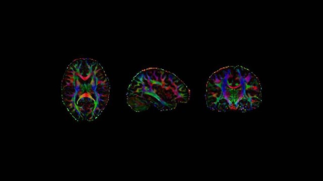Binge-Drinkers' Brains Have To Work Harder To Feel Empathy, Study Suggests