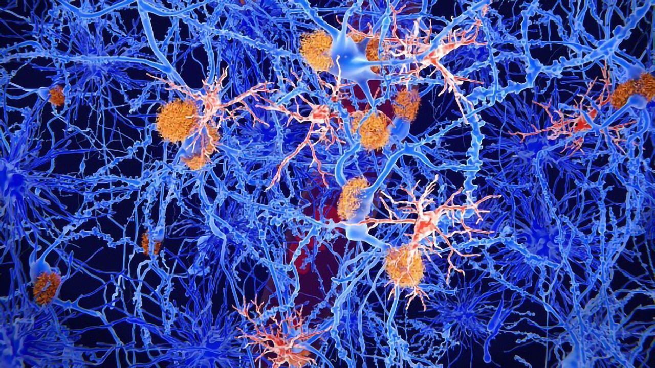 Brain Astrocytes Show Metabolic Alterations in Parkinson’s Disease