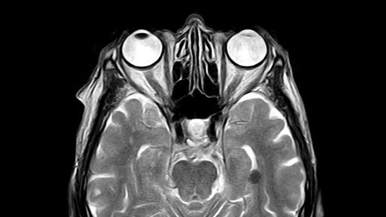 Concussion Discovery Reveals Dire, Unknown Effects of Even Mild Traumatic Brain Injuries