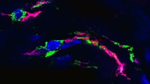 DNA “Nets” Detected in Lungs of COVID-19 Patients