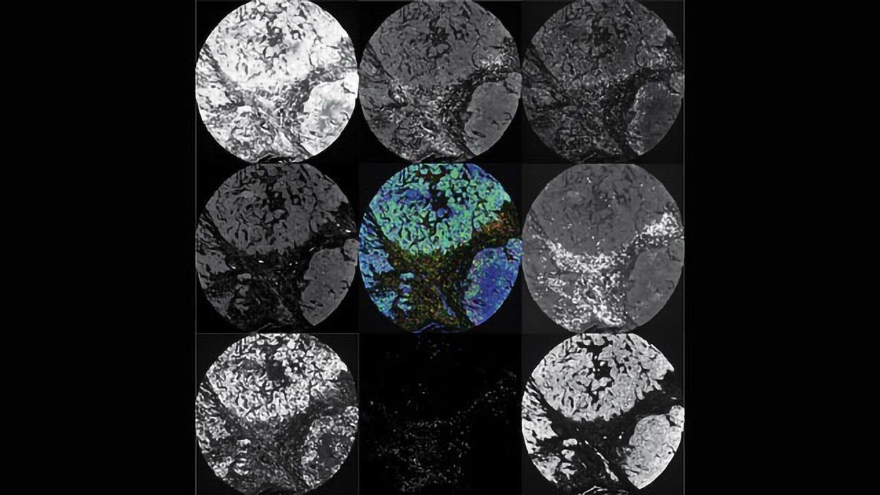The Composition of Ovarian Cancer Tumors Changes During Chemo