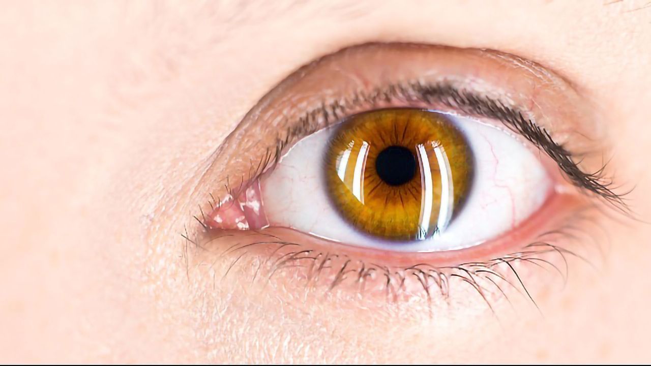 Higher Antioxidant Levels Linked to Protection Against Glaucoma