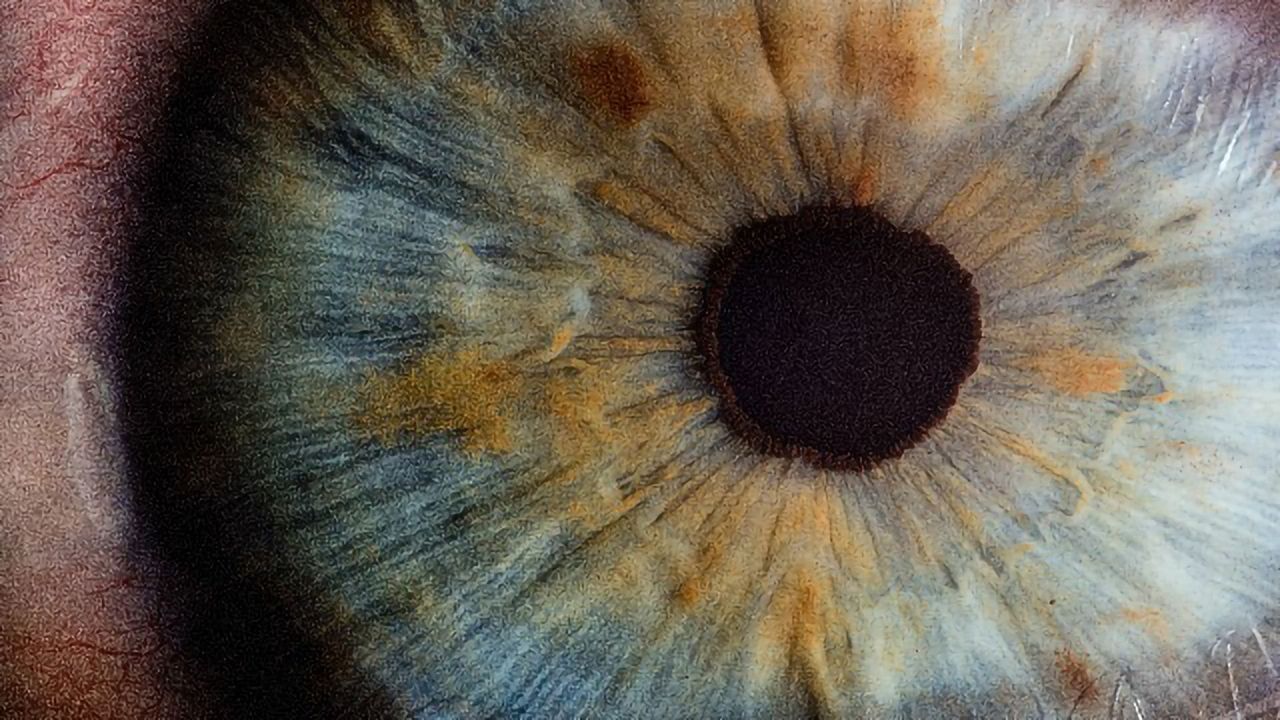 Well-Known Biomarker for Neurodegenerative Disease Detectable in the Eye