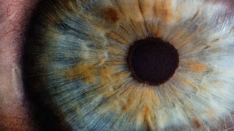 Well-Known Biomarker for Neurodegenerative Disease Detectable in the Eye