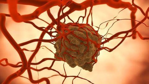 System Developed To Predict Tumor Response to Different Treatments
