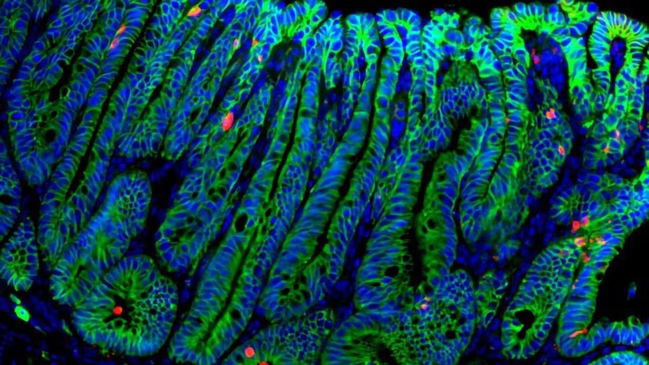 Growth Factor R-spondin Suppresses Colorectal Cancer Growth