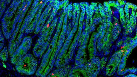 Growth Factor R-spondin Suppresses Colorectal Cancer Growth