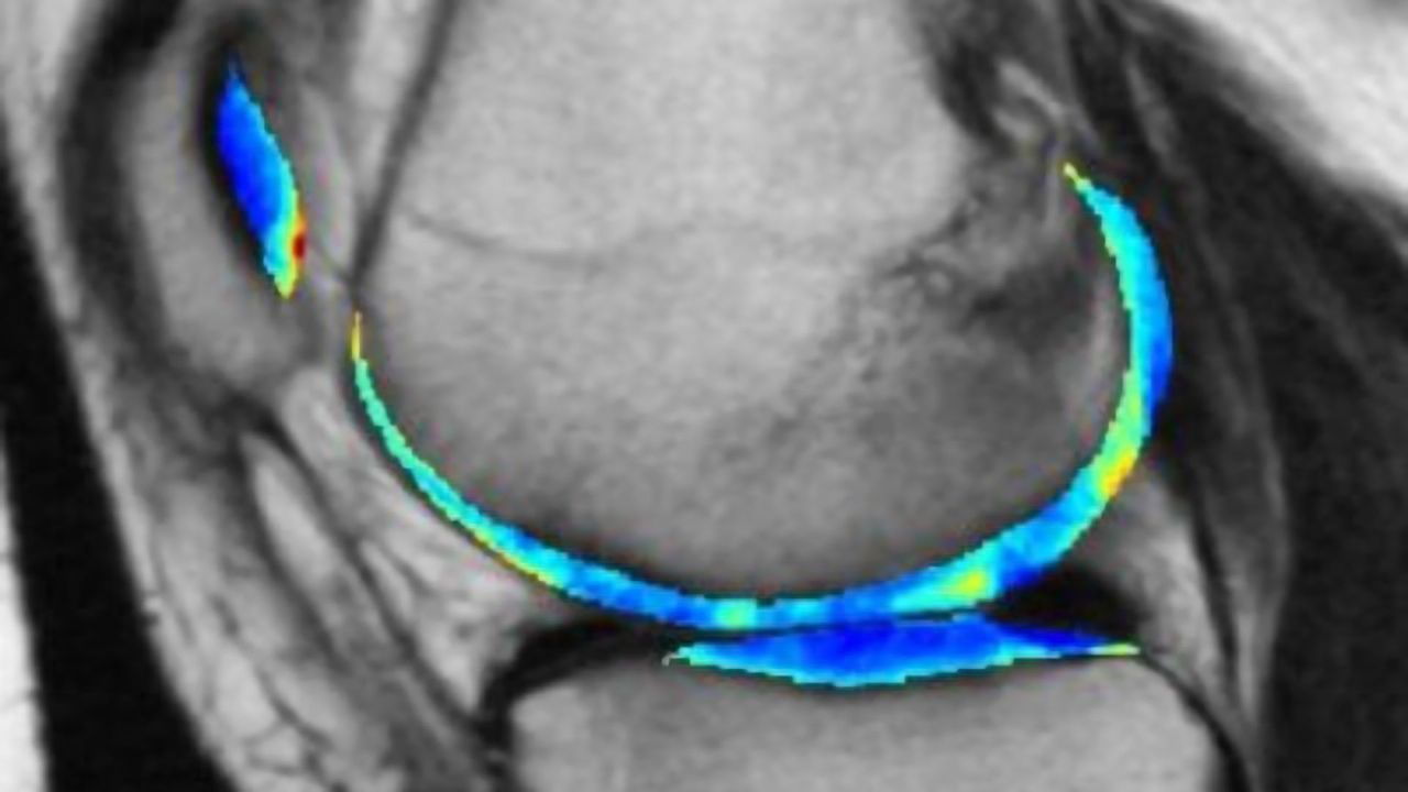 AI Algorithm Detects Osteoarthritis Years Before Symptoms Develop