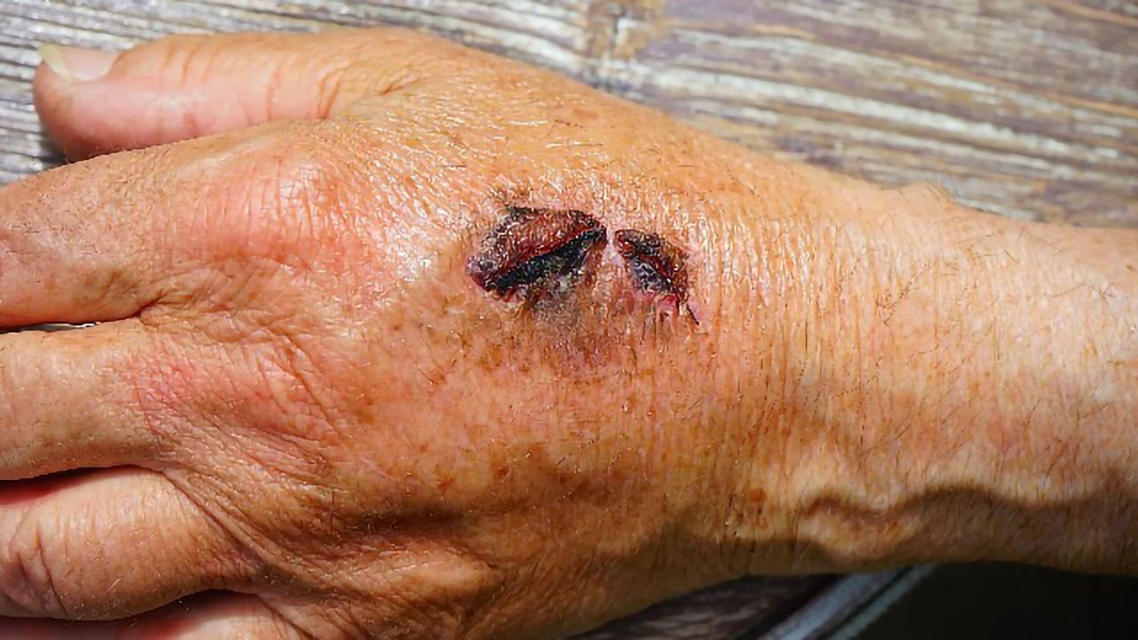 Discovery Enables Adult Skin To Regenerate Like a Newborn’s