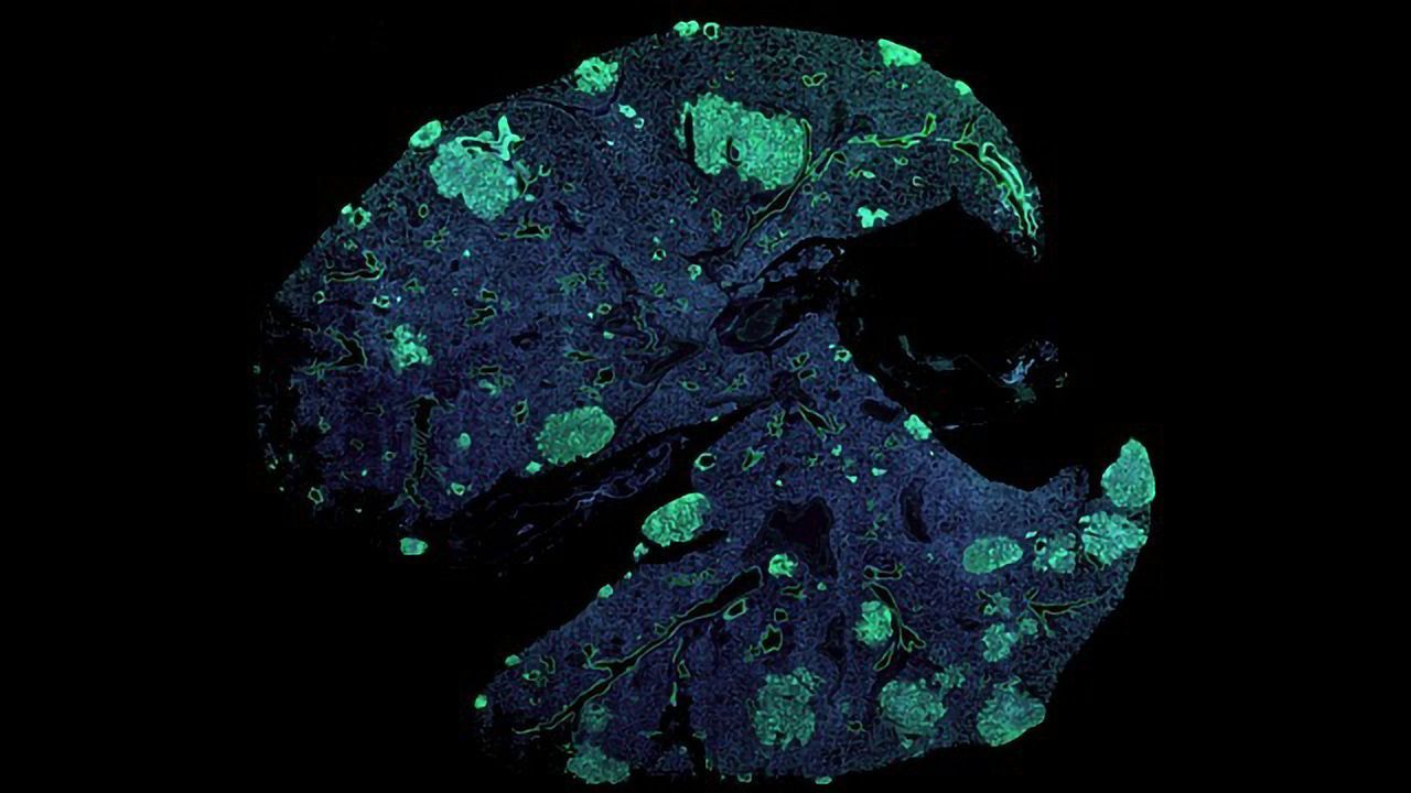 Some Cancer Cells Exploit Neuronal Signaling To Metastasize