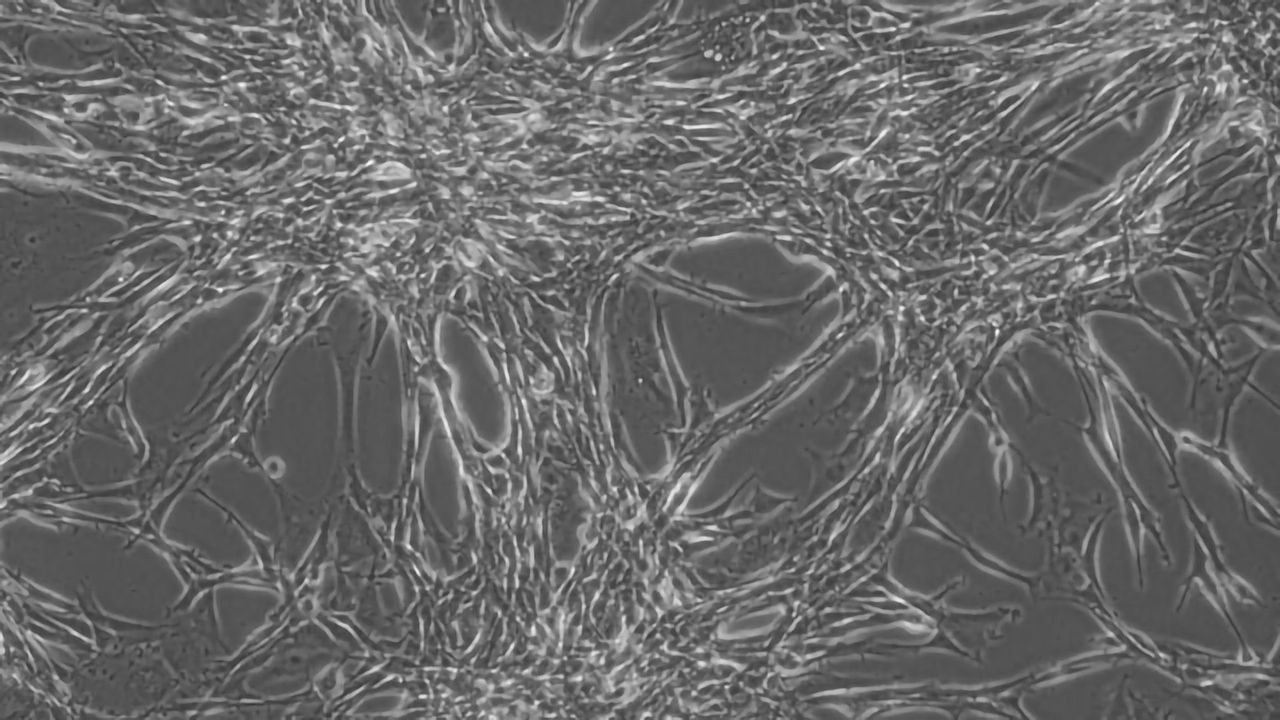 Molecules That Mediate Radioresistance in Glioblastoma Discovered
